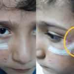 Bursa'da köpek dehşeti! 8 yaşındaki çocuğun yanağını koparıyordu