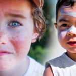 Çocukluktaki güneş yanıkları deri kanseri riskini arttırıyor!