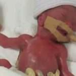 212 gram doğan bebek, 13 aylık yaşam savaşının sonunda taburcu edildi
