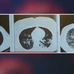 Aşılı ve aşısız hastaların farkı röntgen filminde! İşte üç Kovid hastasının akciğerleri