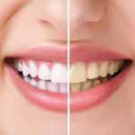 Dişlerde ağartma işlemi bilinçsiz yapıldığında kalıcı hasarlara neden oluyor