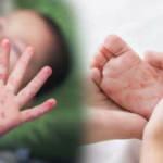 Hem çocuklar hem yetişkinler için kabus: El ayak ağız hastalığı