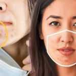 Maskne isimli akneler pandemide artışa geçti!