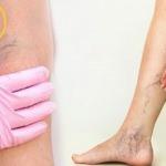 Her 3 kişiden 1'inde görülen varis oluşumunda genetik ve meslek etkili oluyor!