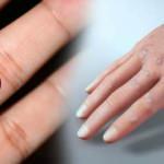 Siğil tedavisinde yeni yöntem: Kriyoterapi