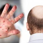 Zona ve saç dökülmesi koronavirüs döneminde artışa geçti!