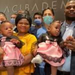 Kamerunlu doğuştan yapışık ikizler Türkiye'de birbirinden ayrıldı