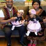 Kamerunlu yapışık ikizler T&uuml;rkiye'de ayrıldı