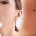 Vücutta hızla yayılan benlere dikkat! Kanserin habercisi olabilir