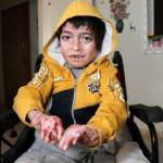 14 yaşındaki kelebek hastası Seyfettin parmaklarına kavuştu