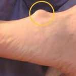 Ganglion kistlerine dikkat! Yanlış ayakkabı neden oluyor