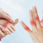 Erkeklerde daha çok görülen romatizmal hastalık: Gut hastalığı