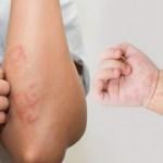 Profesörden omicron uyarısı: Deride kızarıklık ve kabarıklık varsa test yaptırın