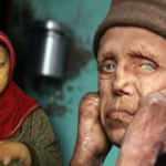 Görülme sıklığı 10 binde 1! Türkiye'de 485 cüzzam hastası var