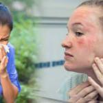 Soğuk alerjisine dikkat! Kaşıntının nedeni olabilir