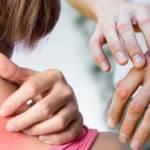 Uzmanı açıkladı! Kaşıntı ve kızarıklıkla ortaya çıkan egzamaya dikkat