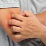 Koronavirüsün bir etkisi daha: Deri döküntüsü, saç dökülmesi