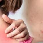 Gece yanığı olarak biliniyor, bağışıklığı düşenlerde görülüyor: Zona hastalığı