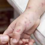 10 soruda 'maymun &ccedil;i&ccedil;eği' hastalığı