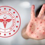 Maymun Çiçeği virüsü nedir, nasıl bulaşır? Belirtileri ve korunma yöntemleri belli oldu