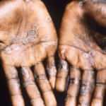 New York'ta ilk maymun &ccedil;i&ccedil;eği vakası tespit edildi