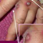 DSÖ'den maymun çiçeği uyarısı: Virüsün fetiş festivalden yayıldığı açıklandı