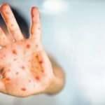 AB ülkelerinde maymun çiçeği vakalarında son rakam 