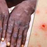 DSÖ, maymun çiçeği virüsünün nasıl bulaştığını açıkladı