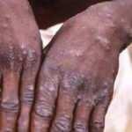 Çocuklara dikkat! Maymun Çiçeği hastalığı uyarısı