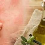 İsilik nedir, nasıl geçer? Yaz aylarında çıkan isiliğe zeytinyağı iyi gelir mi?