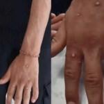 İstanbul'da Maymun Çiçeği alarmı! Hastaneye kaldırıldılar