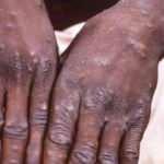 Maymun &ccedil;i&ccedil;eği vir&uuml;s&uuml; bir &uuml;lkede daha g&ouml;r&uuml;ld&uuml;