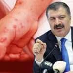 T&uuml;rkiye'de ilk Maymun &Ccedil;i&ccedil;eği vakası tespit edildi! Bakan Koca'dan a&ccedil;ıklama