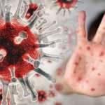  Maymun çiçeği belirtileri nelerdir? Maymun çiçeği virüsü tedavisi...