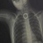 Y&uuml;z&uuml;k yutan 3 yaşındaki &ccedil;ocuk &ouml;l&uuml;mden d&ouml;nd&uuml;  