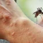 Böcek ısırığı şişmesine ne iyi gelir? Böcek ısırığı belirtileri nelerdir?