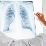 DS&Ouml;'den a&ccedil;ıklama: T&uuml;berk&uuml;loz vakaları artıyor