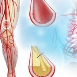Damar tıkanıklığı hangi hastalıkla neden olur? Bacak damar tıkanıklığı belirtileri nelerdir?