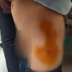 Mardin’de başıboş sokak köpekleri 6 yaşındaki çocuğu ısırıp hastanelik etti 