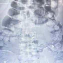 Yolcunun midesinden 1 kilo 134 gram Afyon sakızı &ccedil;ıktı