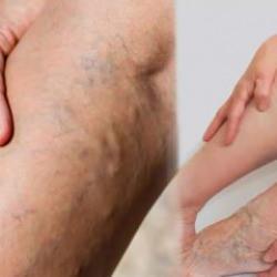 Varis nedir, neden olur? Genç yaşta ve bacakta varis belirtileri…