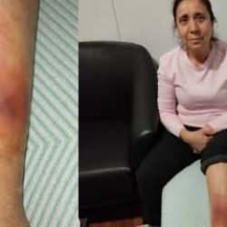 Hatay'da k&ouml;pek saldırısına uğrayan kadının bacağında yarık oluştu