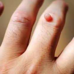 Evde doğal siğil tedavisi! Elde siğil neden çıkar, nasıl geçer?