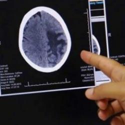 Demans ile ilgili umut vadeden bir gelişme! Yıllar öncesinden tanı konulabilecek