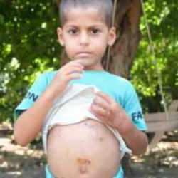 Köpeklerin saldırısına uğrayan çocuk ölümden döndü: 18 gün sonra taburcu oldu