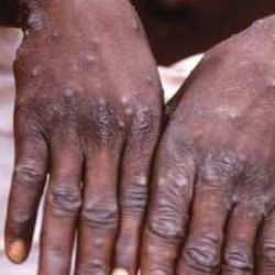 Telaşlandıran yeni salgın! Hızla yayılıyor: Y&uuml;zlerce &ouml;l&uuml;, binlerce vaka var