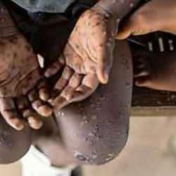 Afrika'da Maymun Çiçeği salgını: Acil durum ilan edildi