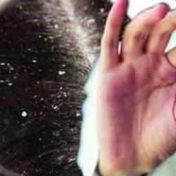 Aspirin ile kepek sorunu nasıl çözülür? Aspirin ile kepek sorununa etkili ve ekonomik çözüm