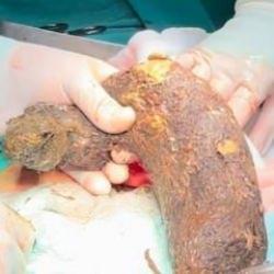 Karın ağrısıyla hastaneye gitti, midesinden 50 santim sa&ccedil; &ccedil;ıktı!