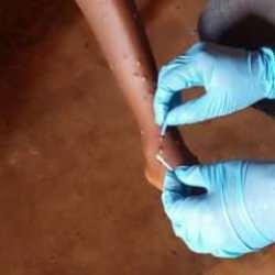 Kongo Demokratik Cumhuriyeti'nde M çiçeği bilançosu artıyor